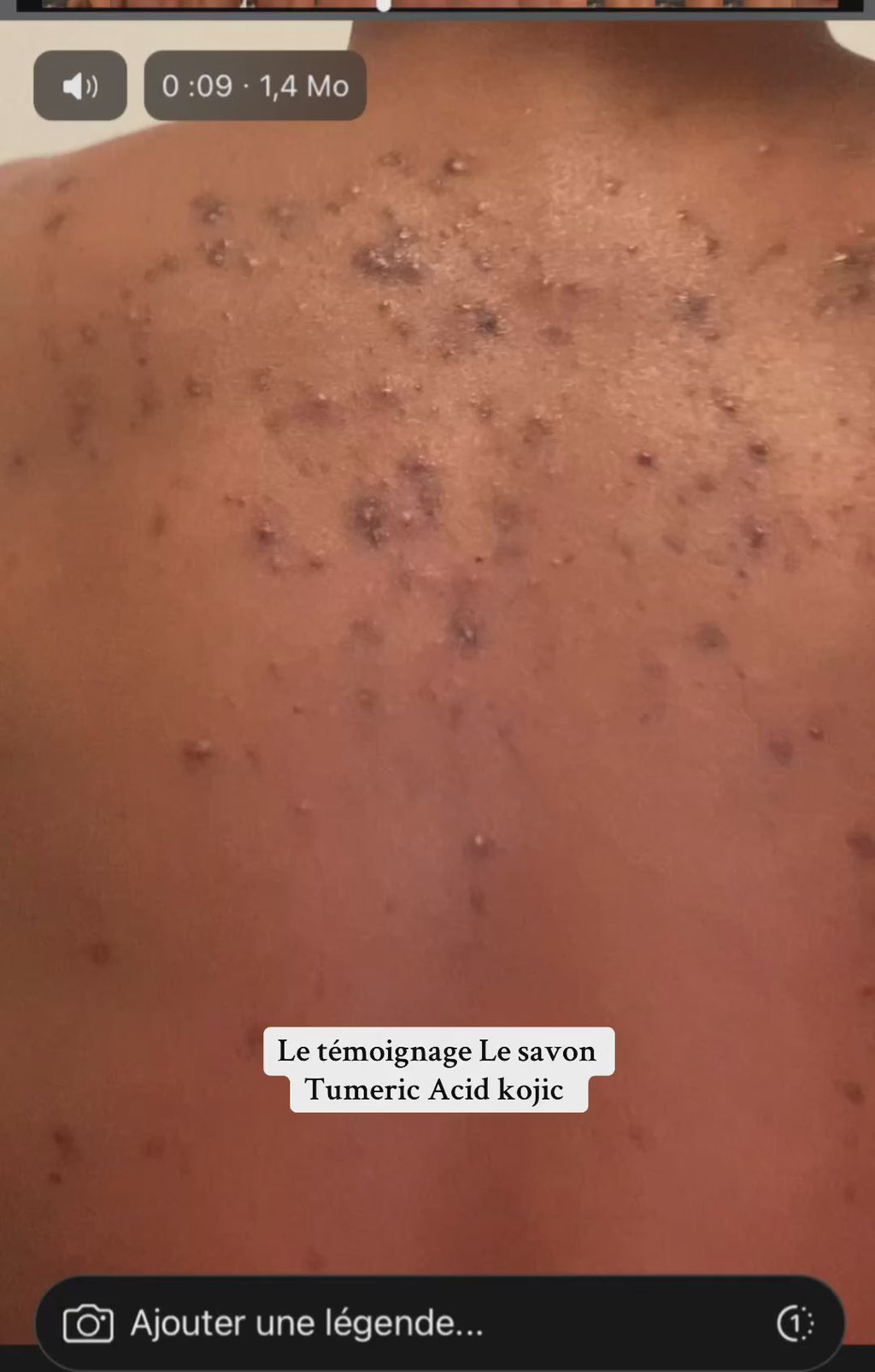 Avant et Après utilisation du Savon Tumeric acide kojic