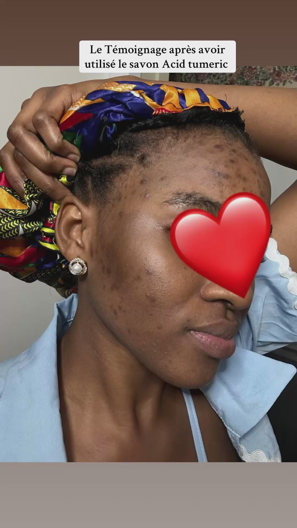 Avant et Après utilisation du Savon Tumeric acide kojic