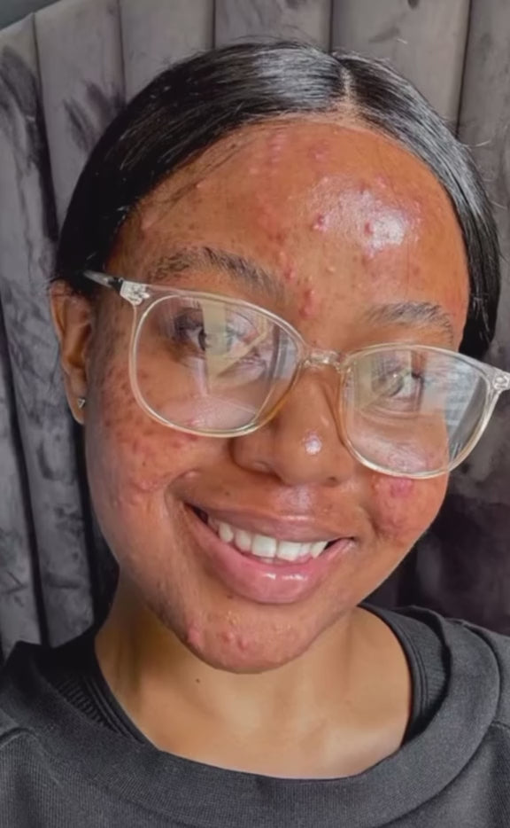 Avant et Après utilisation du Savon Tumeric acide kojic